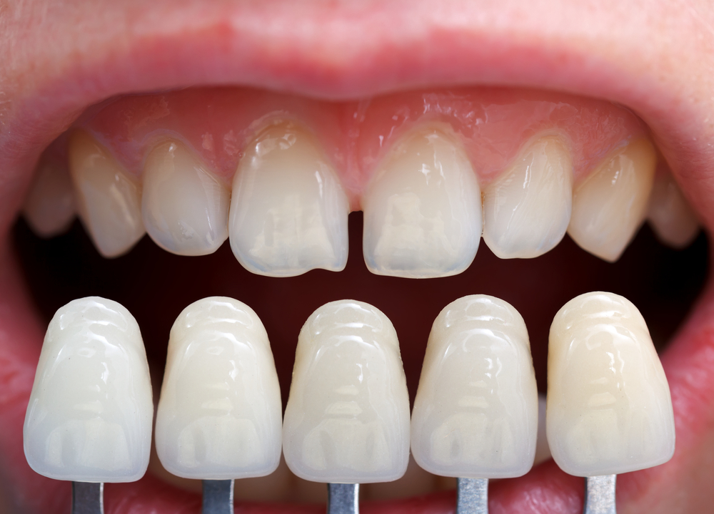Dental implant Kocaeli
